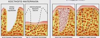 Остеопластика в стоматологии - аутотрансплантация, синус-лифтинг, наращивание кости