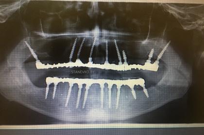Протезирование МА-коронками на базальных имплантах Roott - рентген-снимок