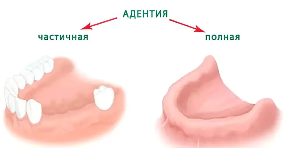 Тотальная и частичная адентия