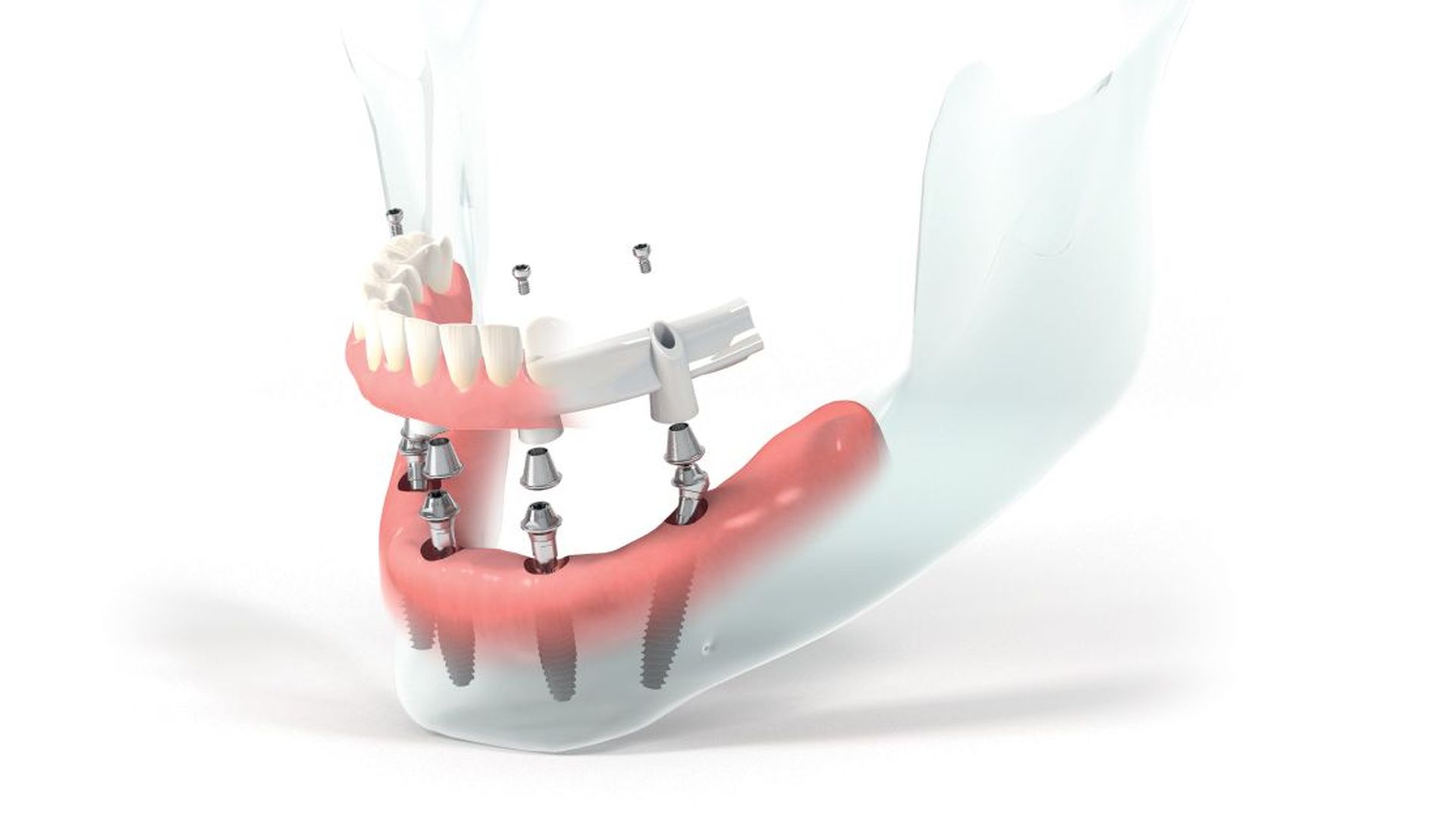 All-on-5-6-8 имплантация