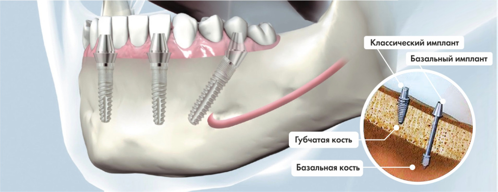 Базальная имплантация