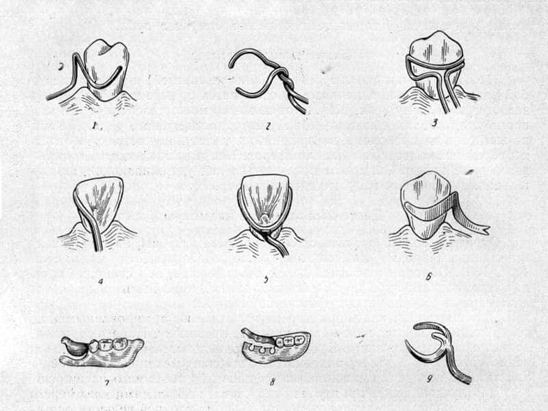 Виды кламмеров для бюгельного протезирования - Фото