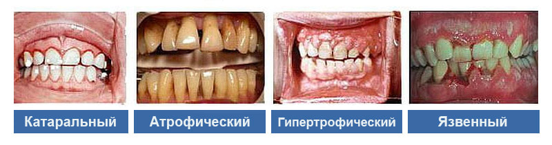 Катаральный, язвенный, гипертрофический гингивит