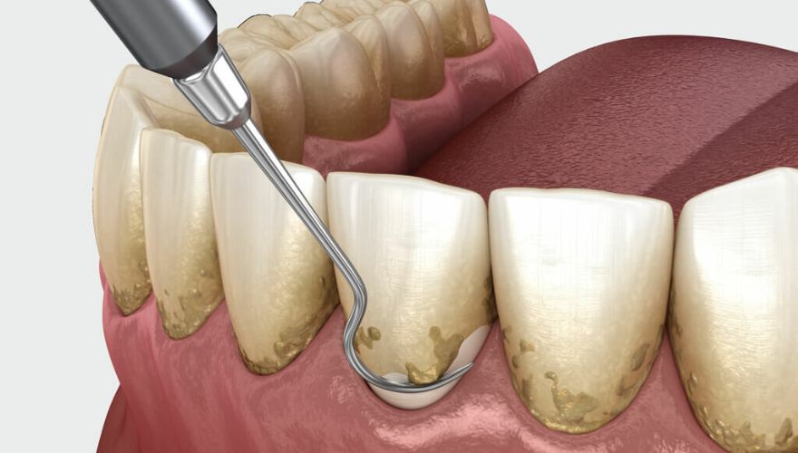 Зубной камень — из-за чего образуется, опасности и способы распознавания