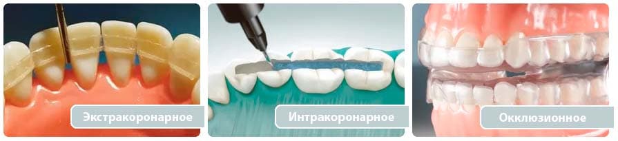 Экстракоронарное, интракоронарное и окклюзионное шинирование зубов