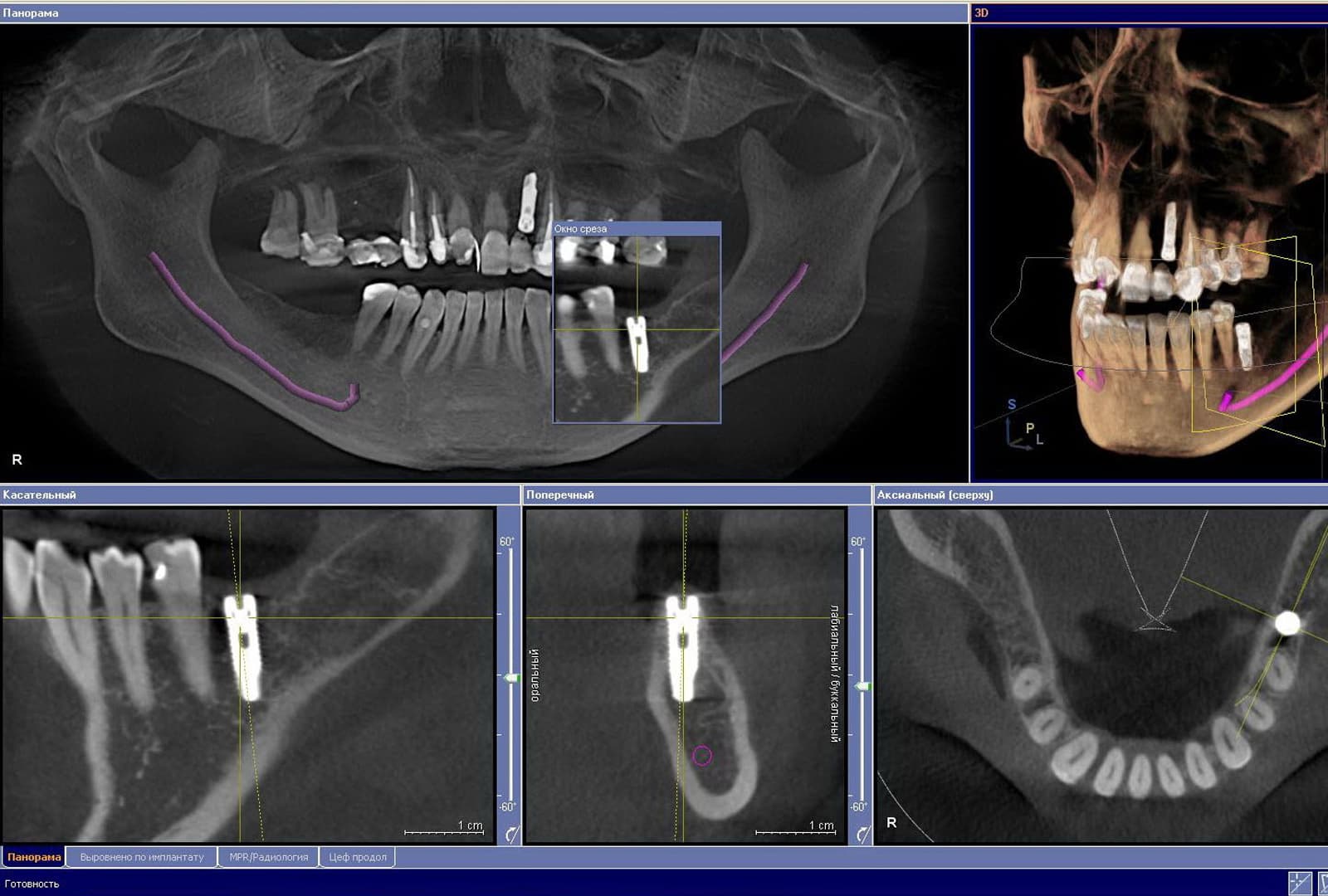 Компьютерная томография при имплантации зубов