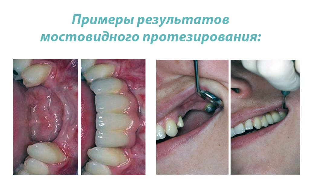 Несъемный мостовидный зубной протез – До и после
