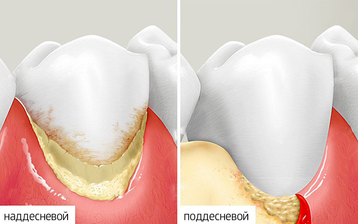 Наддесневый и поддесневый зубной камень