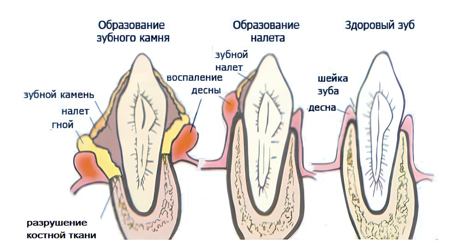 Опасность зубного камня