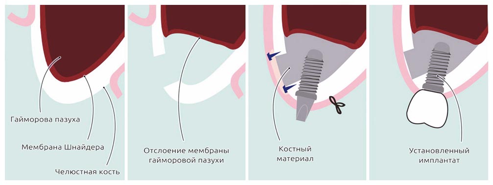 Открытый синус-лифтинг