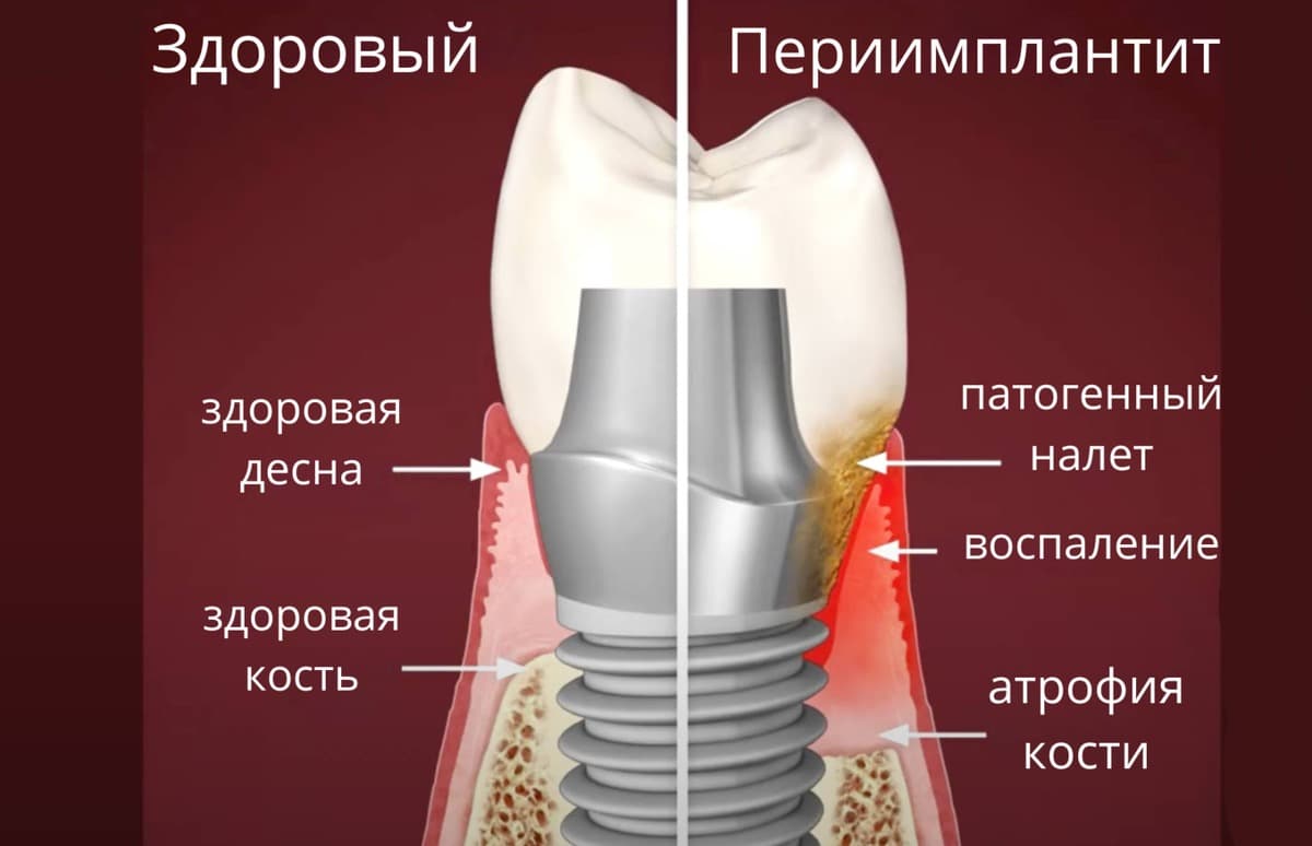 Периимплантит