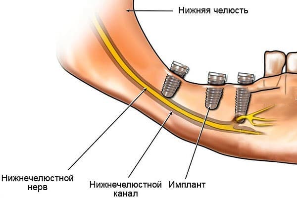 Повреждение нижнечелюстного нерва при имплантации зубов