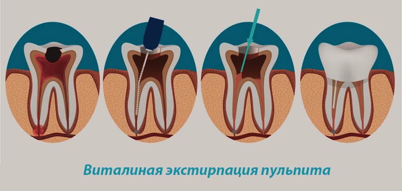 Экстирпация пульпита