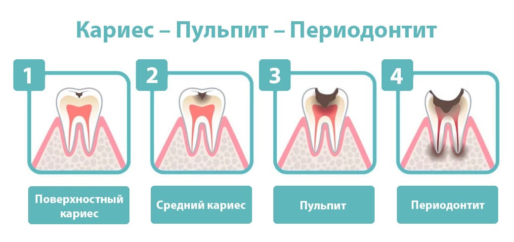 Пульпит и кариес отличия