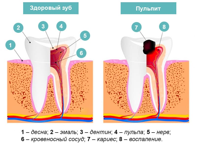 Зубная боль – как избавиться быстро в домашних условиях