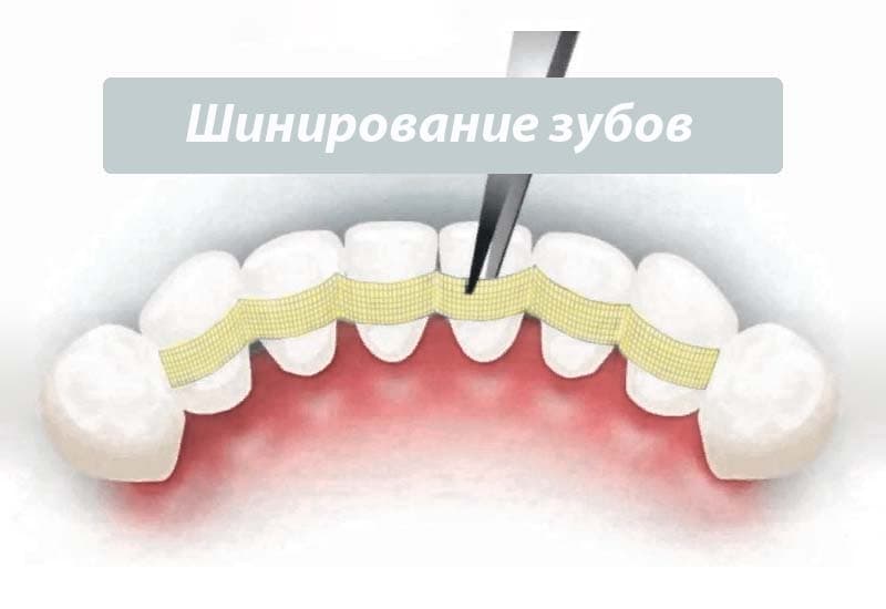 Шинирование зубов - что это и зачем нужно?