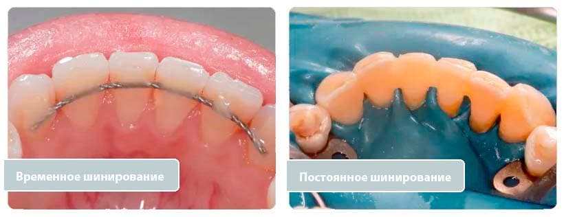 Временное и постоянное шинирование зубов