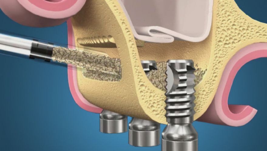 FAQ: Можно ли провести синус лифтинг и имплантацию одновременно