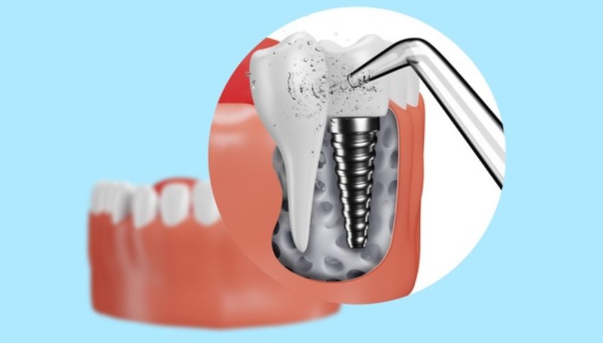 Рекомендации по уходу за зубными имплантами