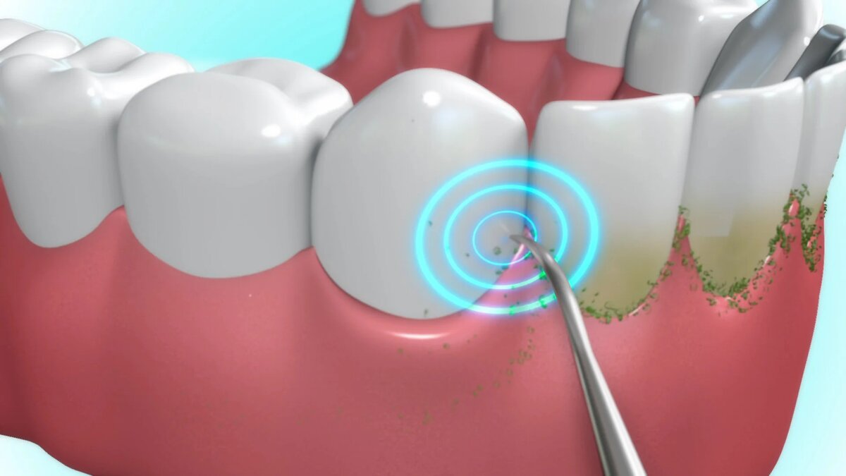 Ультразвуковая чистка зубов