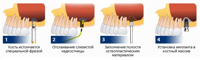 Закрытый синус-лифтинг