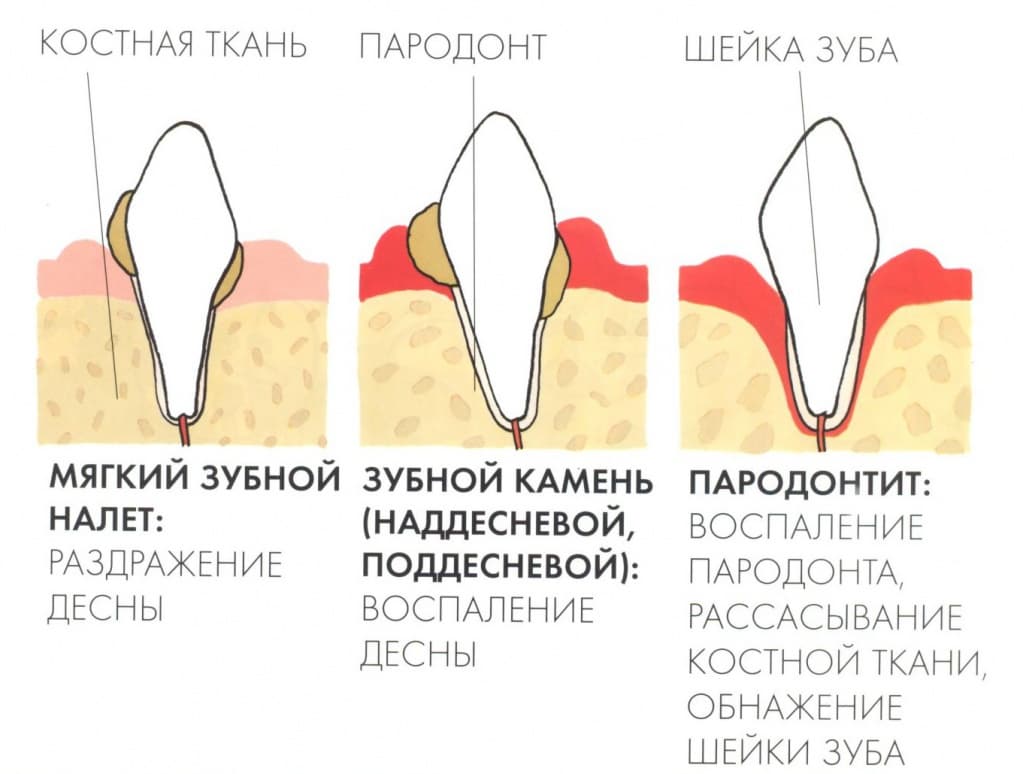 Зубной камень - осложнения