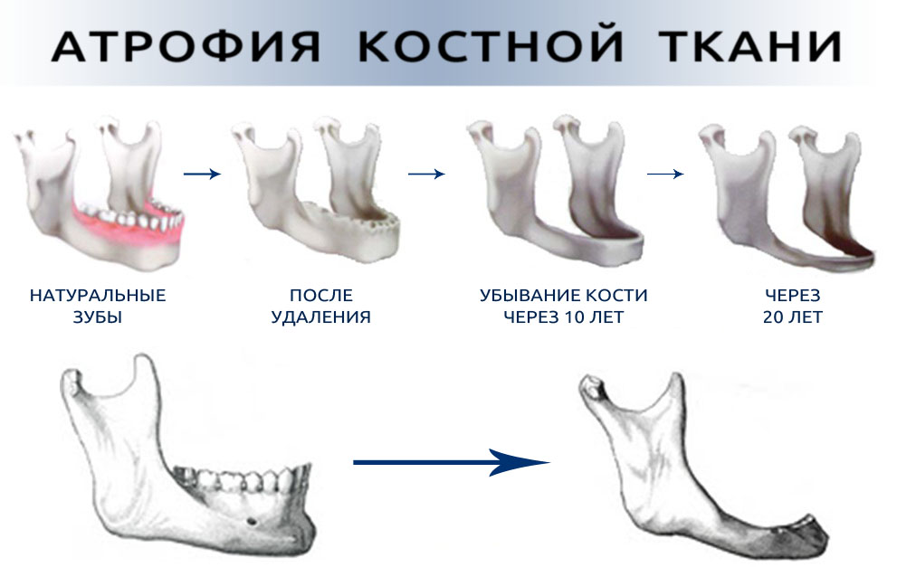 4 способа укрепить кости