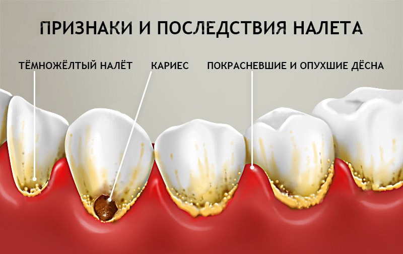 Чем опасен зубной камень