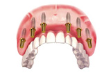 Комплексная имплантация «All On 6»