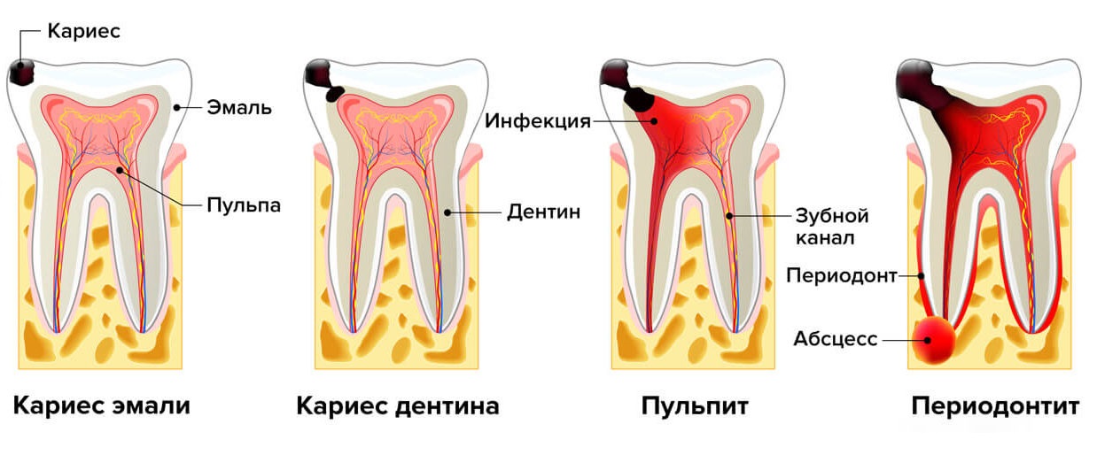 Пульпа десны. Кариес эмали дентина и цемента. Этапы пульпита периодонтит.