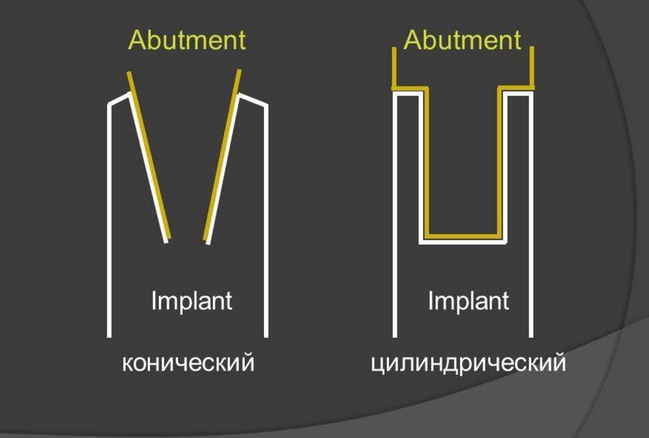 Типы соединения абатмента с имплантом