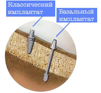 Чем отличается базальный имплант от классического?