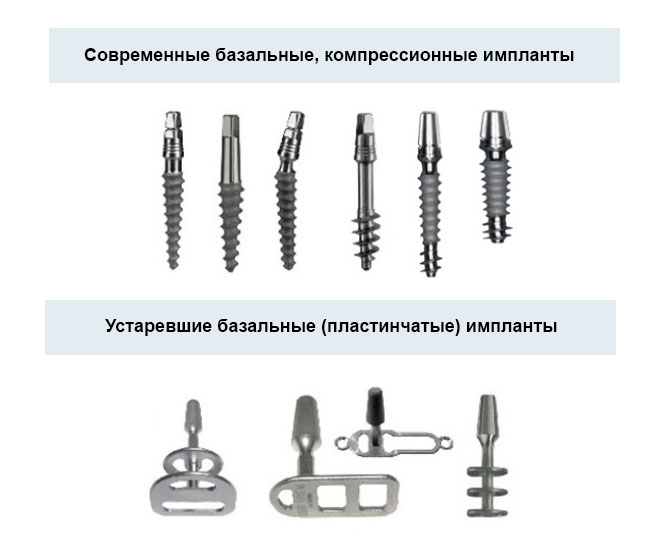 Базальная имплантация. Базальной имплантация методика. Базальный и компрессионный импланты. Базальная пластинчатые имплантация зубов.