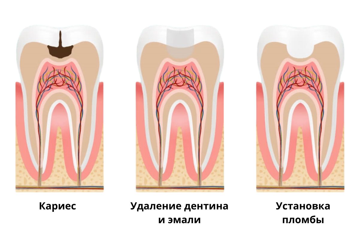 Консервативный метод лечения пульпита