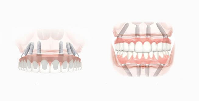 Полная имплантация зубов по методу All-On-4/6