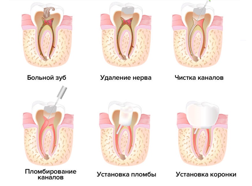 Хирургическое лечение пульпита