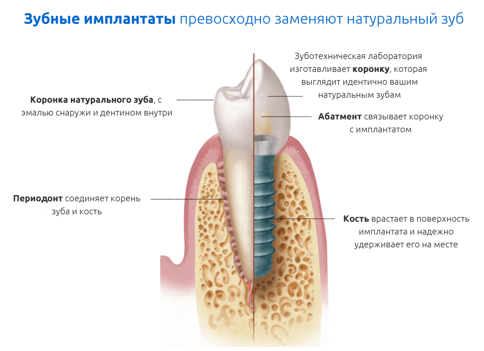 Имплантация зубов фото поэтапно