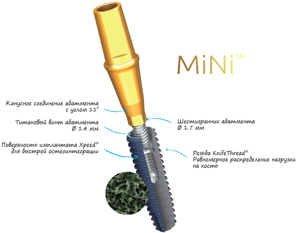 Минусы имплантации