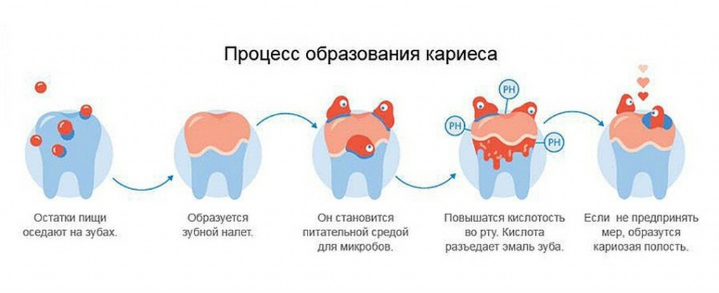 Процесс образования кариеса