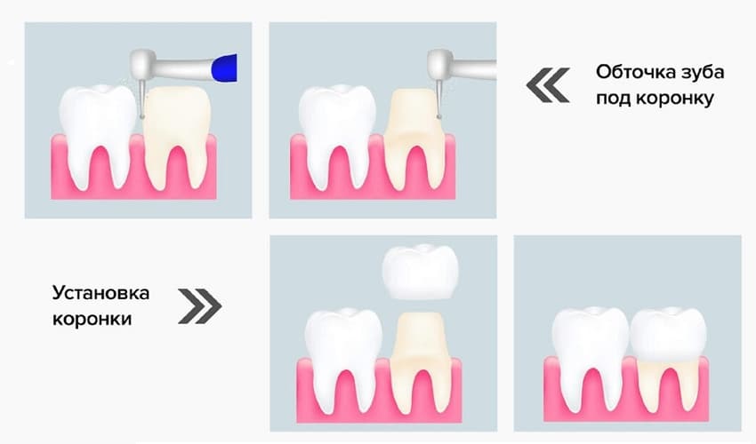 Обточка зуба под коронку