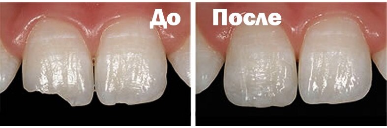 Восстановление передних зубов пломбой