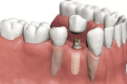 Протезирование зубов на имплантах