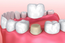 Протезирование зубными коронками