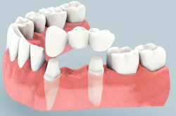 Протезирование мостовидными протезами