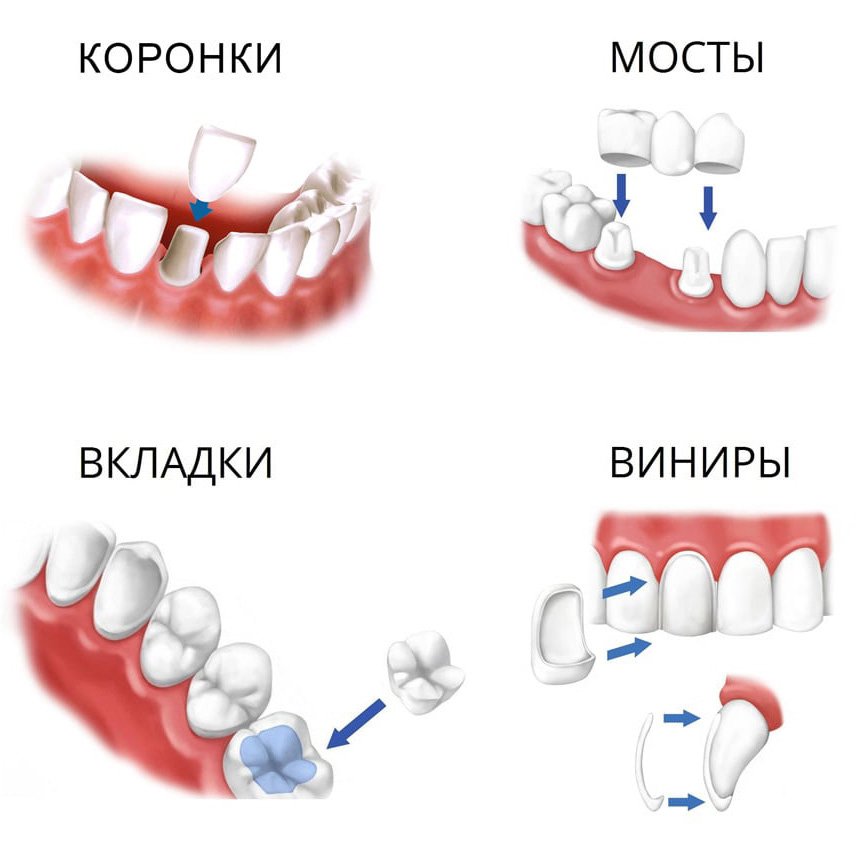 несъемное протезирование зубов