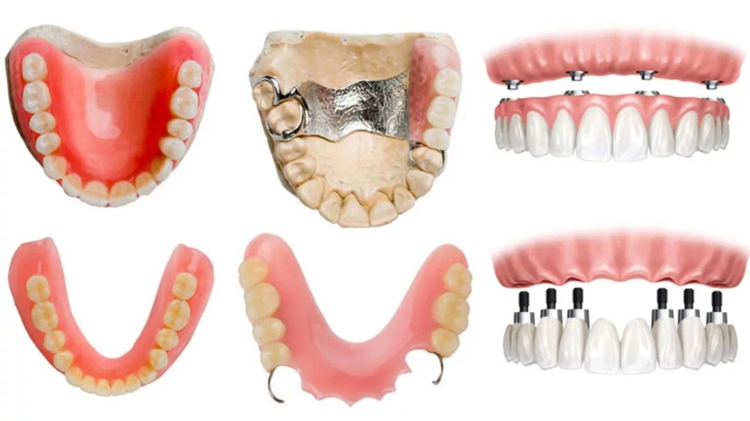 Виды протезирования зубов