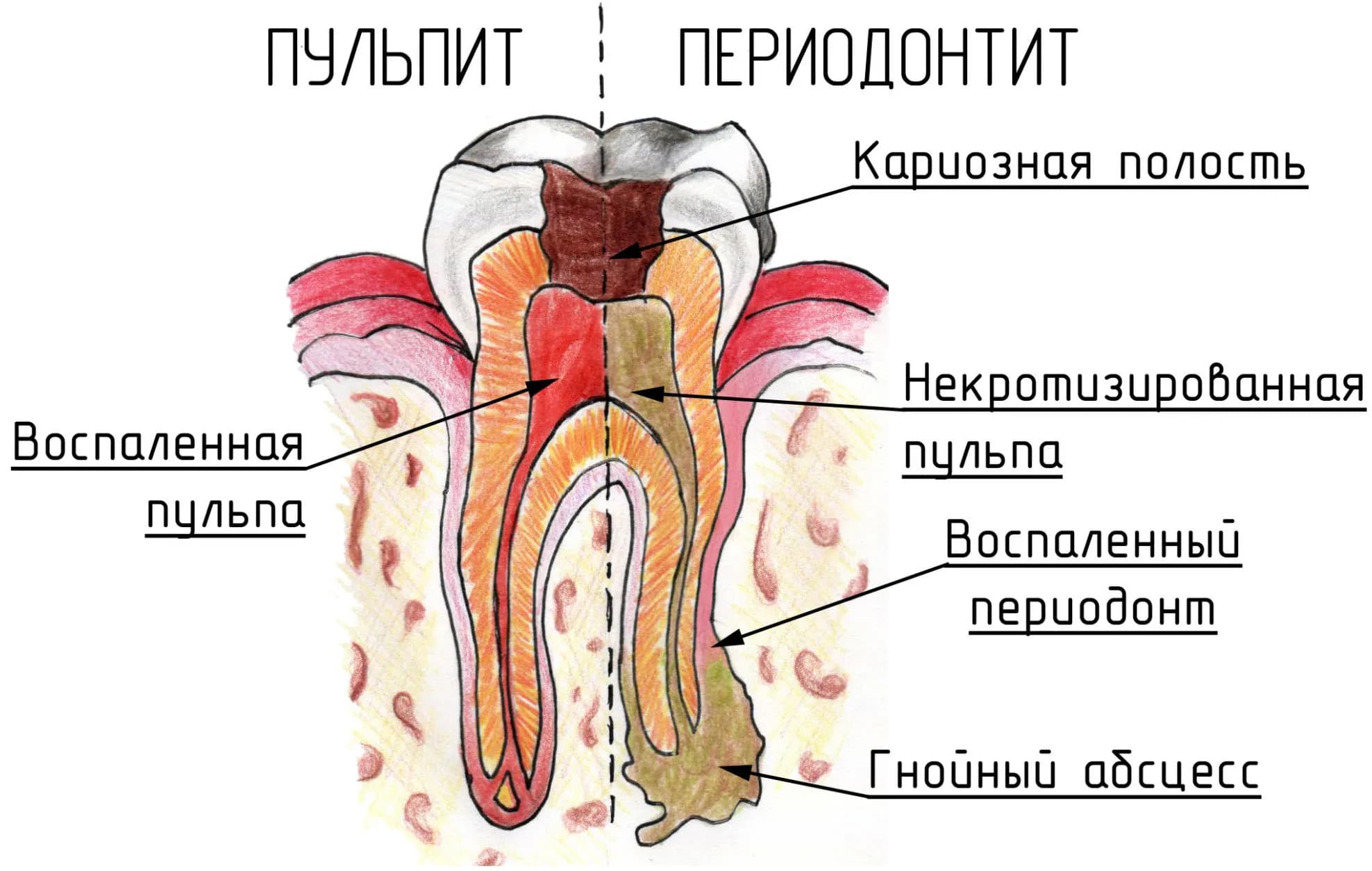 Развитие периодонтита из пульпита