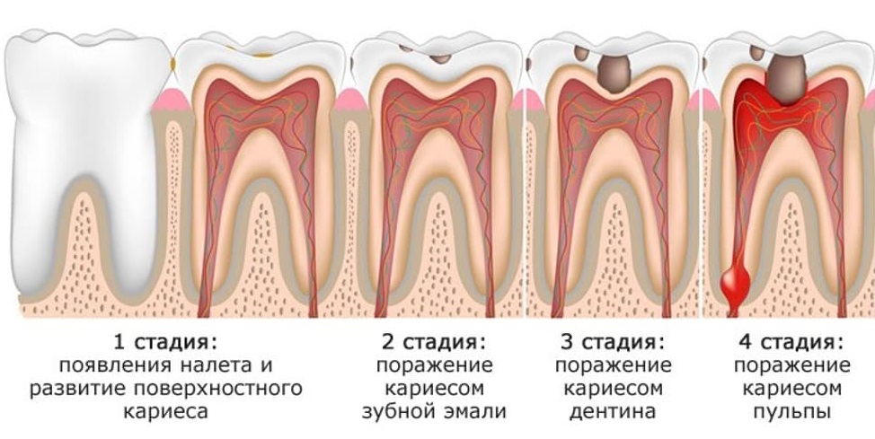 Стадии развития пульпита