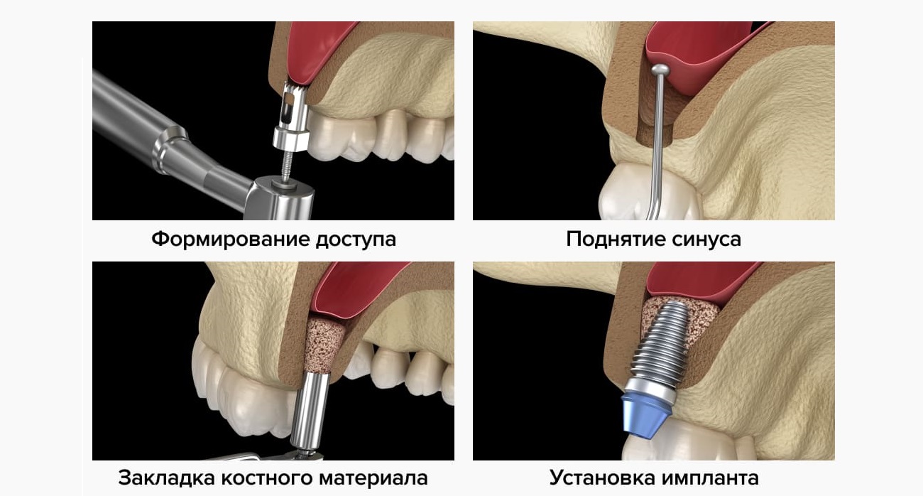 Синус-лифтинг при имплантации зубов