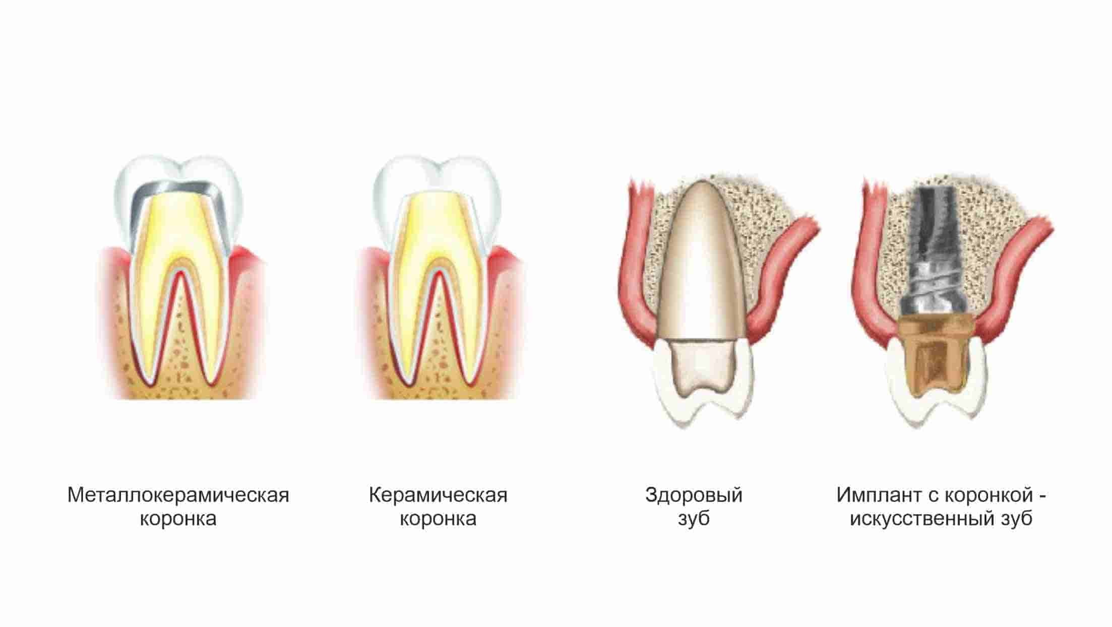 Керамические и металлокерамические коронки